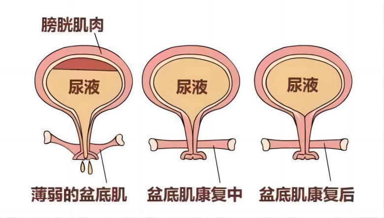 羽豐醫(yī)療丨如何有效運用振動提高盆底肌肉激活水平？